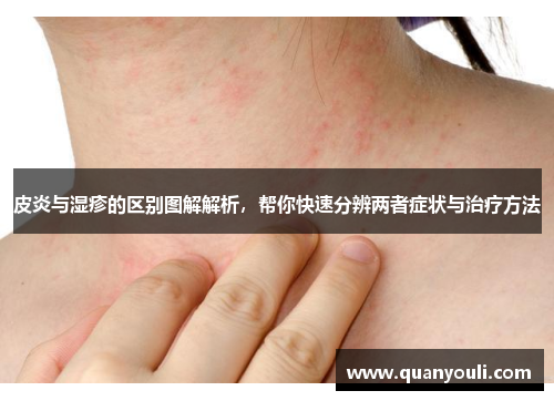 皮炎与湿疹的区别图解解析，帮你快速分辨两者症状与治疗方法